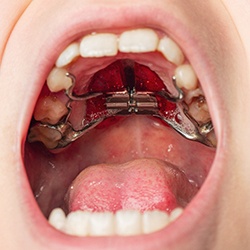 A child with a palate expander