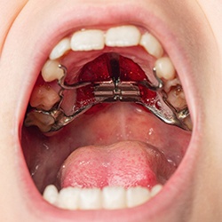 Child with a palatal expander