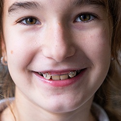 Little girl wearing metal appliances