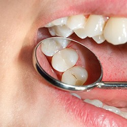 Dental mirror showing a child’s dental sealants 